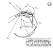 External- internal lever with two nodal points 43